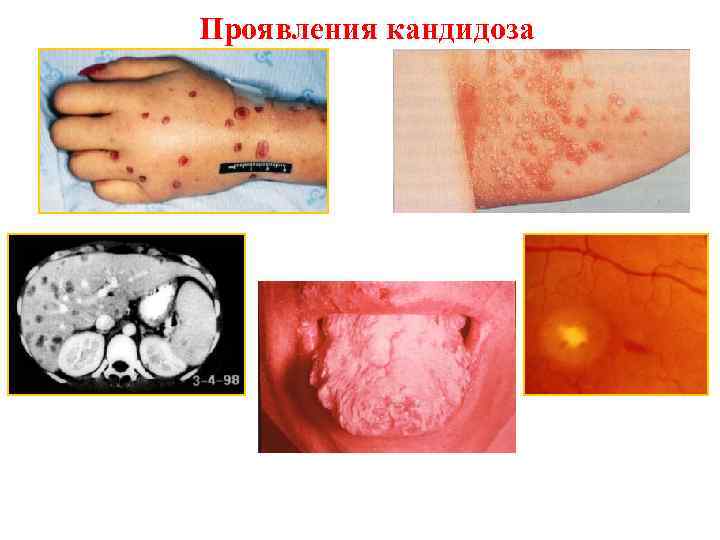 Проявления кандидоза 