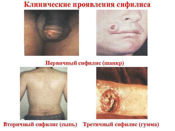 Клинические проявления сифилиса Первичный сифилис (шанкр) Вторичный сифилис (сыпь) Третичный сифилис (гумма) 