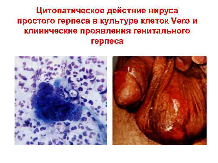 Цитопатическое действие вируса простого герпеса в культуре клеток Vero и клинические проявления генитального герпеса