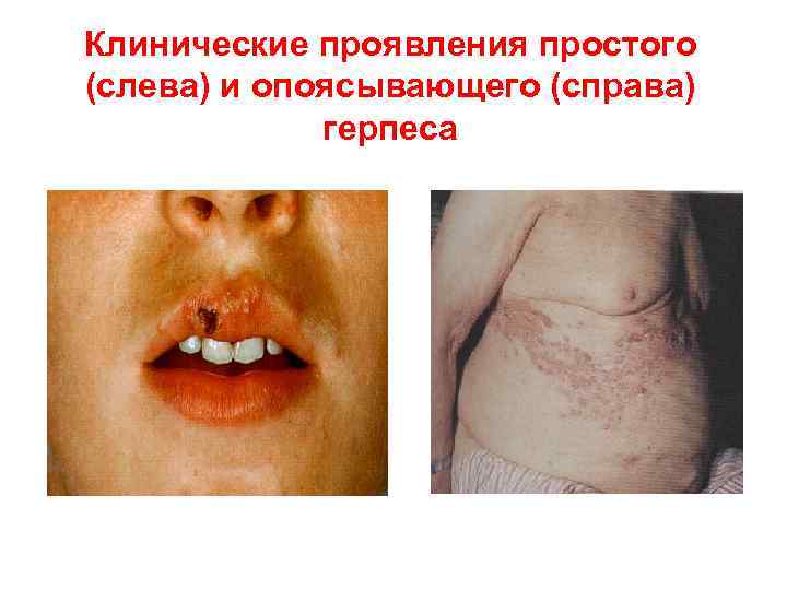 Клинические проявления простого (слева) и опоясывающего (справа) герпеса 