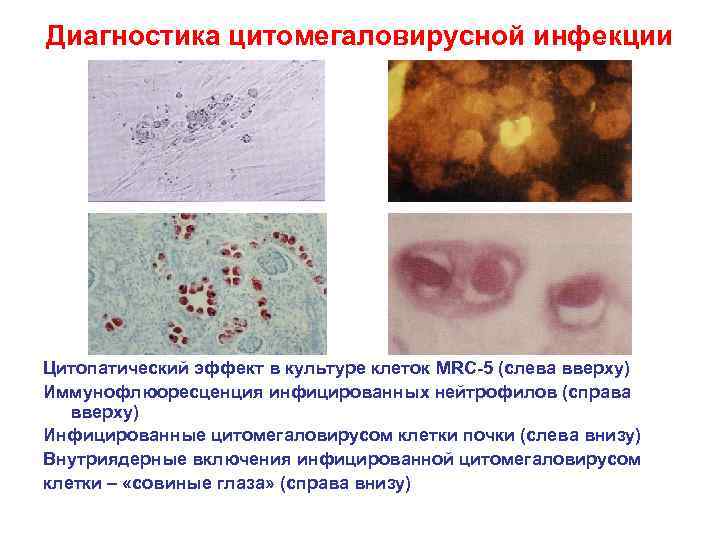 Диагностика цитомегаловирусной инфекции Цитопатический эффект в культуре клеток MRC-5 (слева вверху) Иммунофлюоресценция инфицированных нейтрофилов
