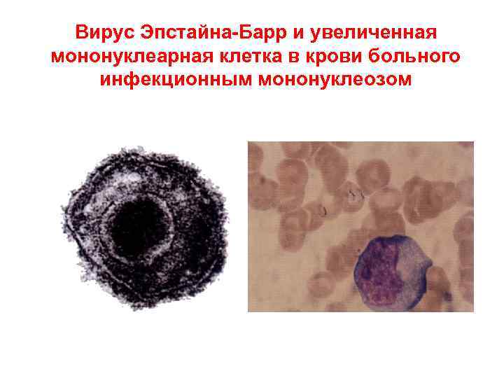Вирус Эпстайна-Барр и увеличенная мононуклеарная клетка в крови больного инфекционным мононуклеозом 