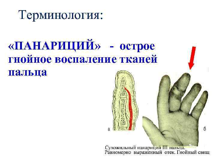 Терминология: «ПАНАРИЦИЙ» - острое гнойное воспаление тканей пальца 