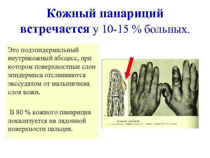Кожный панариций встречается у 10 -15 % больных. Это подэпидермальный внутрикожный абсцесс, при котором