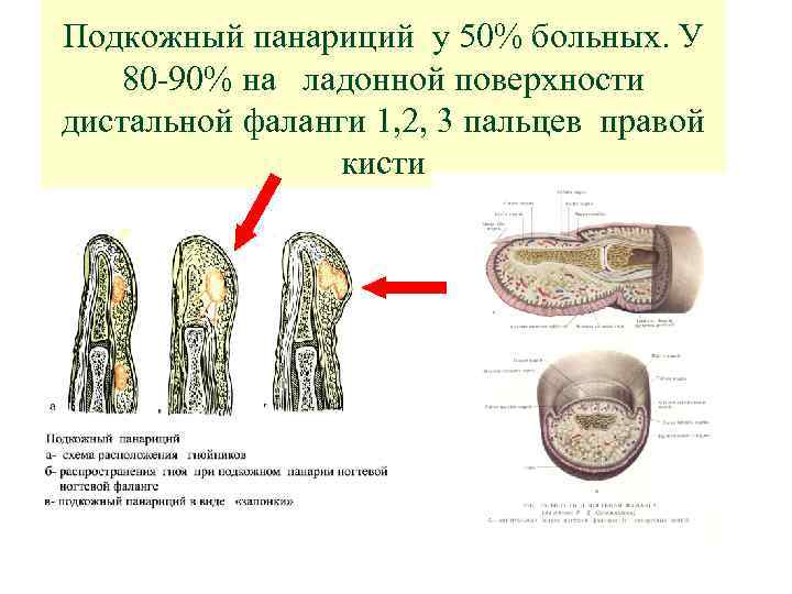 Панариций - Панариций - Справочник MSD …