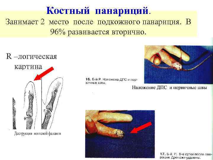 Костный панариций. Занимает 2 место после подкожного панариция. В 96% развивается вторично. R –логическая