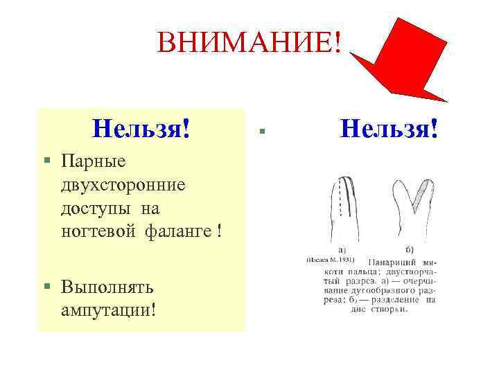 ВНИМАНИЕ! Нельзя! § Парные двухсторонние доступы на ногтевой фаланге ! § Выполнять ампутации! §