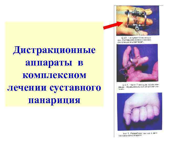 Дистракционные аппараты в комплексном лечении суставного панариция 