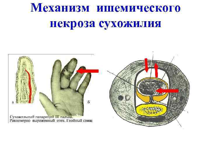 Механизм ишемического некроза сухожилия 