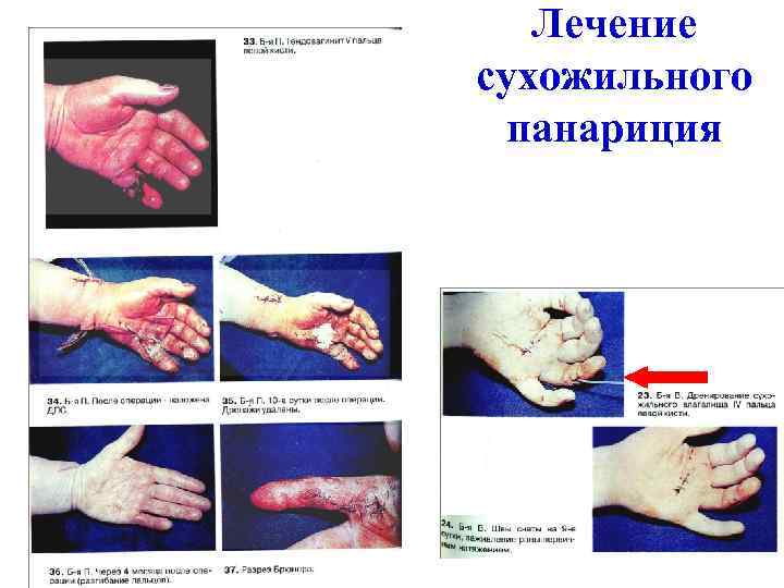 Лечение сухожильного панариция 