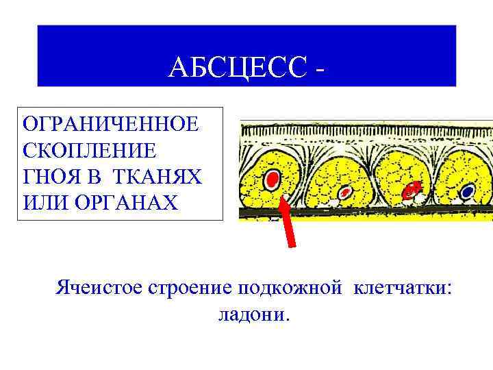 АБСЦЕСС ОГРАНИЧЕННОЕ СКОПЛЕНИЕ ГНОЯ В ТКАНЯХ ИЛИ ОРГАНАХ Ячеистое строение подкожной клетчатки: ладони. 