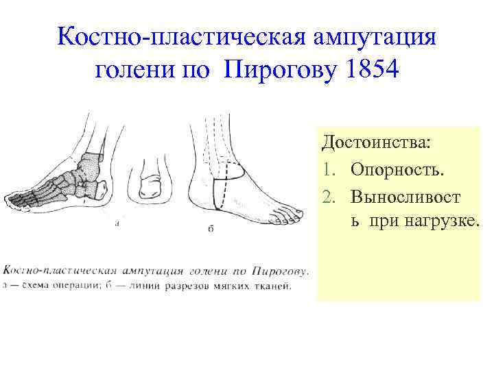 Костно-пластическая ампутация голени по Пирогову 1854 Достоинства: 1. Опорность. 2. Выносливост ь при нагрузке.