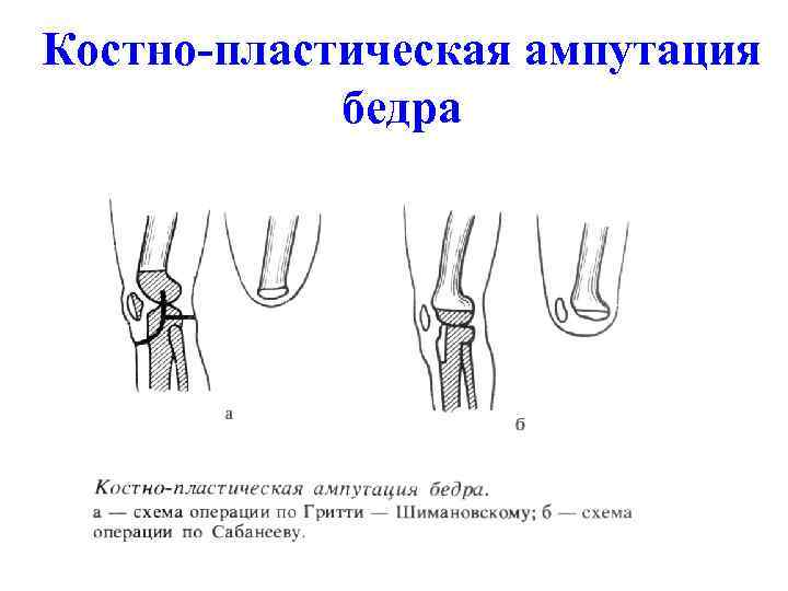 Круговая ампутация