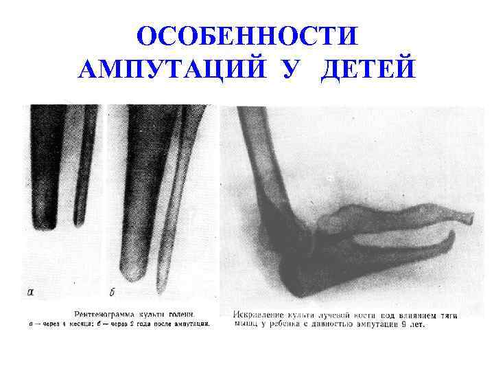 Облитерирующий эндартериит презентация