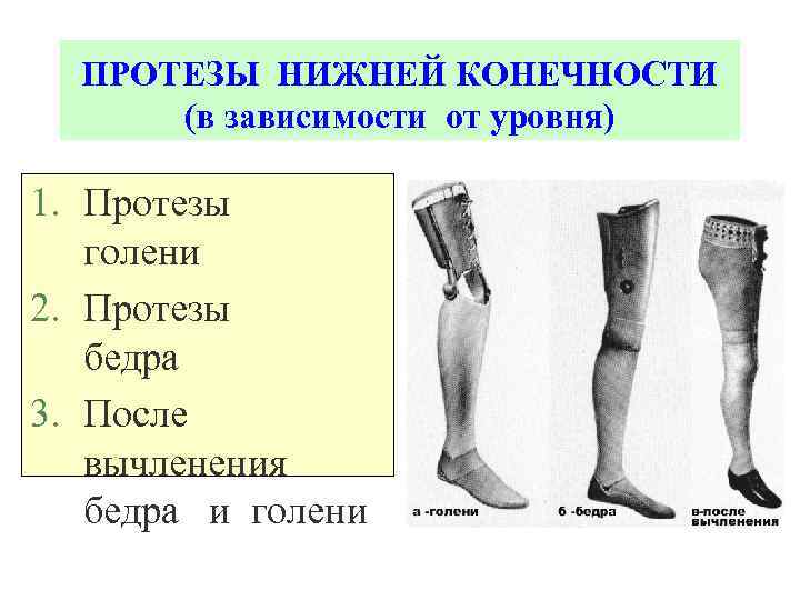 ПРОТЕЗЫ НИЖНЕЙ КОНЕЧНОСТИ (в зависимости от уровня) 1. Протезы голени 2. Протезы бедра 3.