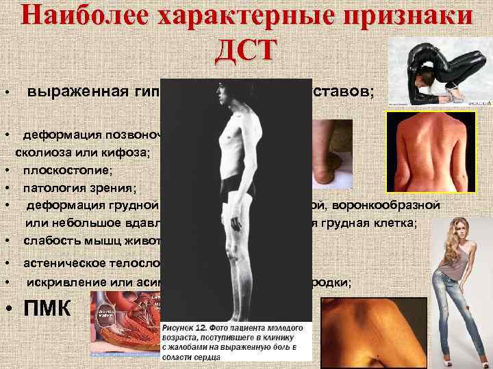 Наиболее характерные признаки ДСТ • • выраженная гипермобильность суставов; деформация позвоночника в виде сколиоза
