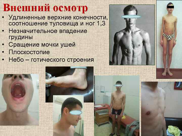 Внешний осмотр • Удлиненные верхние конечности, соотношение туловища и ног 1, 3 • Незначительное