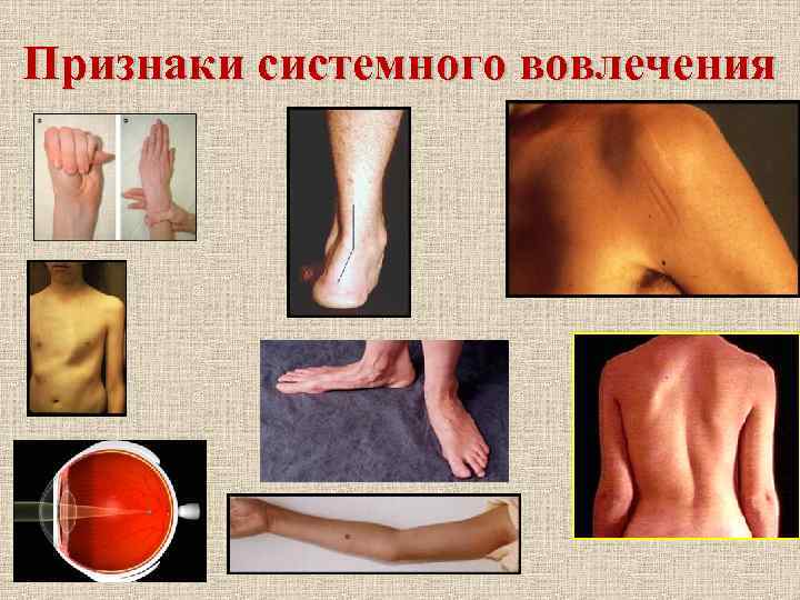 Признаки системного вовлечения 