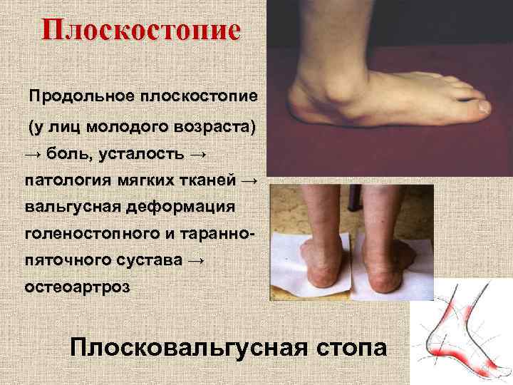 Плоскостопие Продольное плоскостопие (у лиц молодого возраста) → боль, усталость → патология мягких тканей
