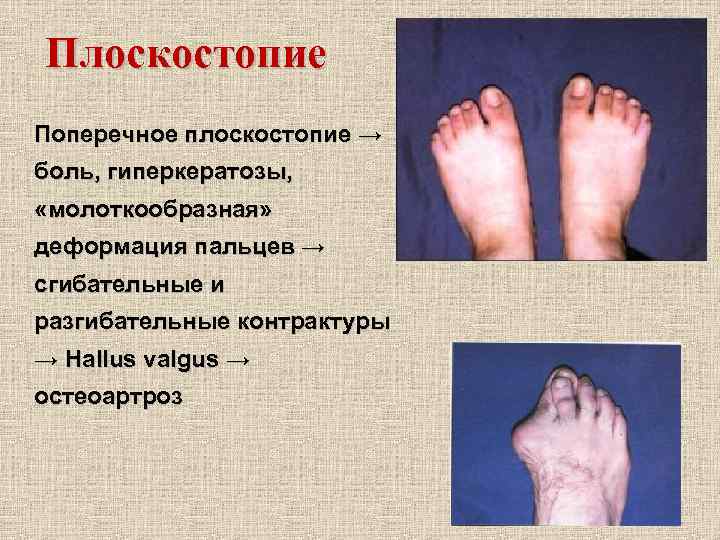 Плоскостопие Поперечное плоскостопие → боль, гиперкератозы, «молоткообразная» деформация пальцев → сгибательные и разгибательные контрактуры