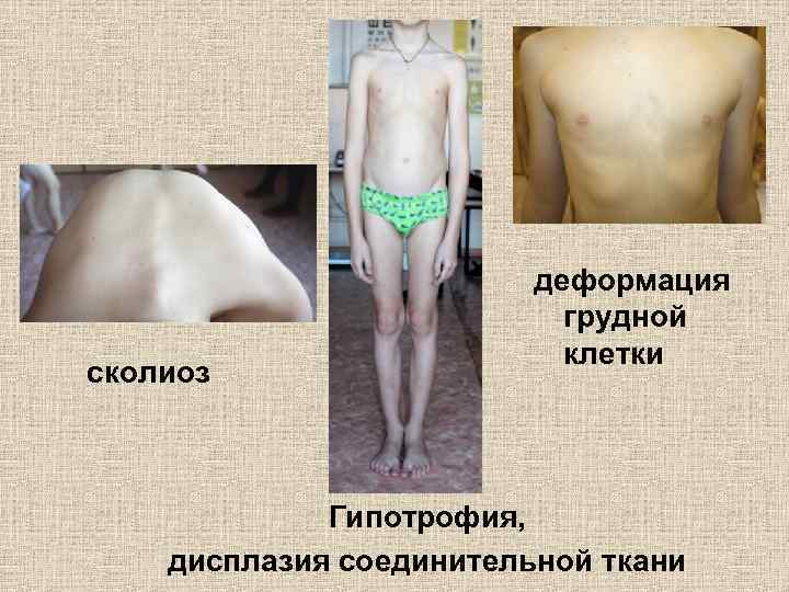 сколиоз деформация грудной клетки Гипотрофия, дисплазия соединительной ткани 