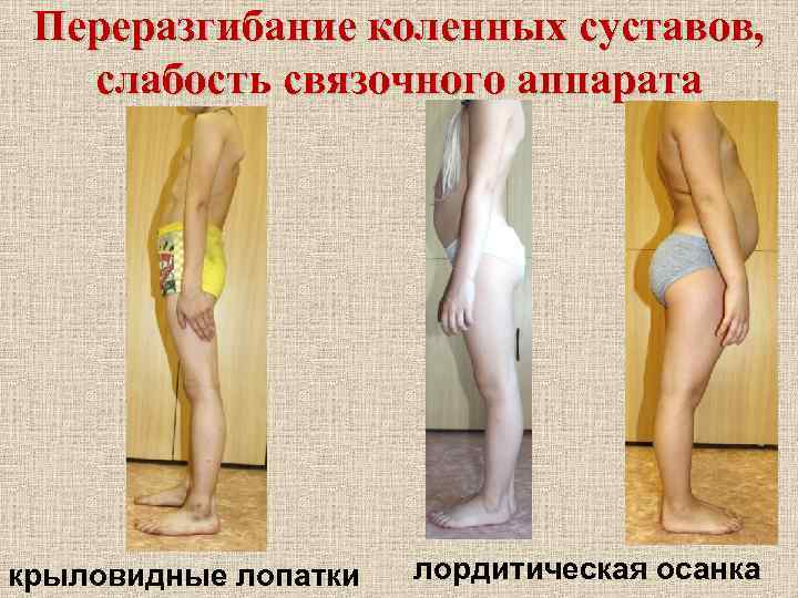 Переразгибание коленных суставов, слабость связочного аппарата крыловидные лопатки лордитическая осанка 