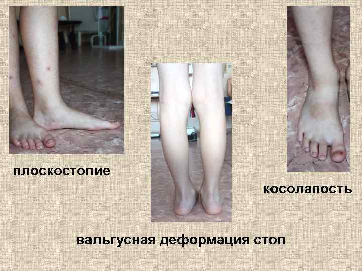 плоскостопие косолапость вальгусная деформация стоп 