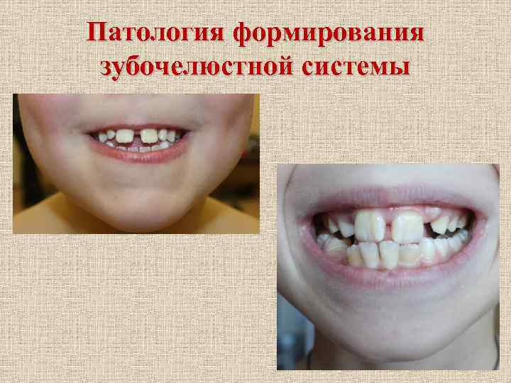 Патология формирования зубочелюстной системы 