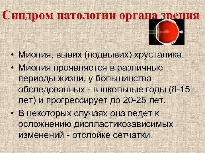 Синдром патологии органа зрения • Миопия, вывих (подвывих) хрусталика. • Миопия проявляется в различные