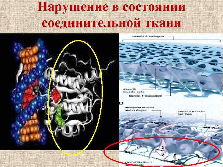 Нарушение в состоянии соединительной ткани 