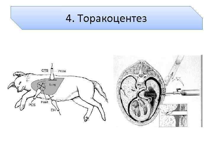 4. Торакоцентез 