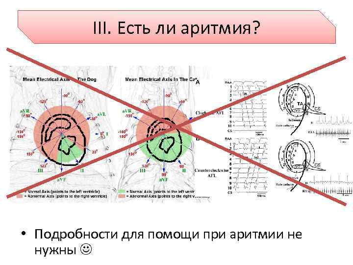 III. Есть ли аритмия? • Подробности для помощи при аритмии не нужны 