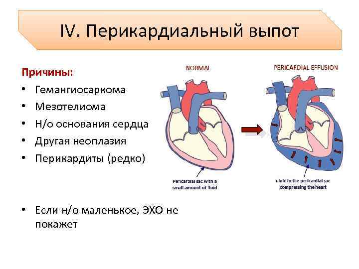 IV. Перикардиальный выпот Причины: • Гемангиосаркома • Мезотелиома • Н/о основания сердца • Другая