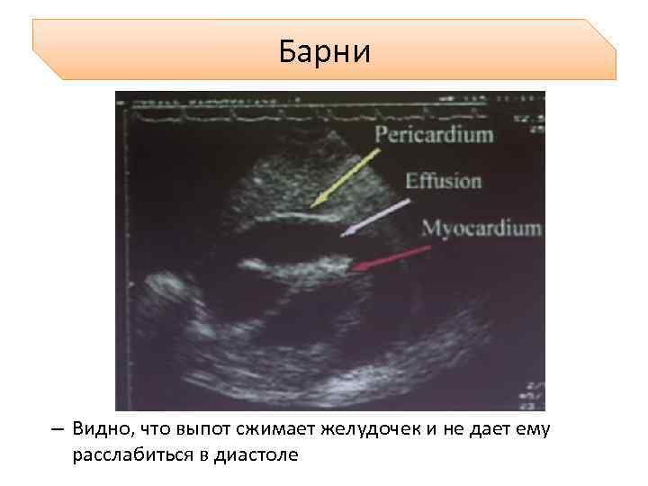 Барни – Видно, что выпот сжимает желудочек и не дает ему расслабиться в диастоле