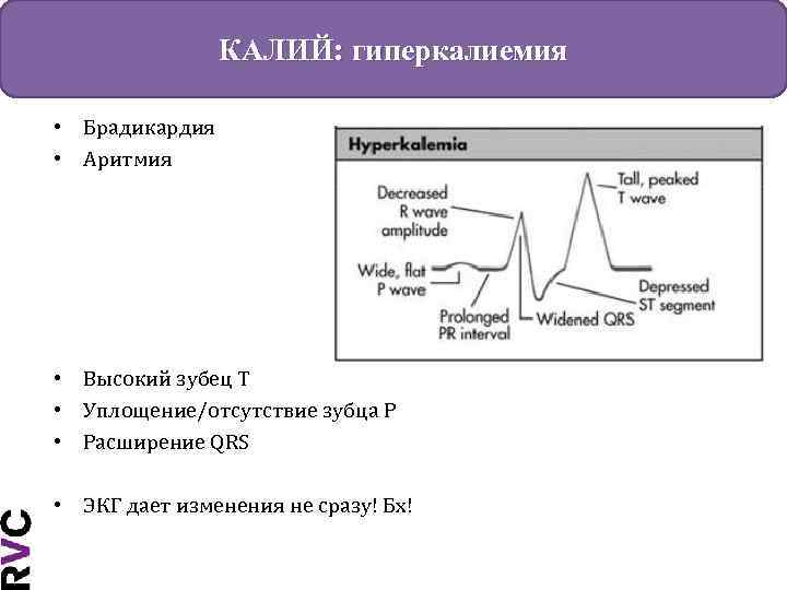 КАЛИЙ: гиперкалиемия • Брадикардия • Аритмия • Высокий зубец Т • Уплощение/отсутствие зубца Р