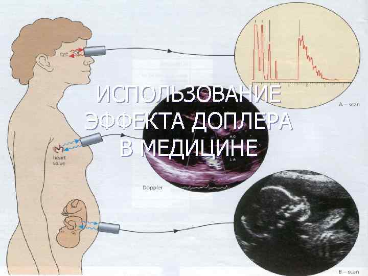 ИСПОЛЬЗОВАНИЕ ЭФФЕКТА ДОПЛЕРА В МЕДИЦИНЕ 