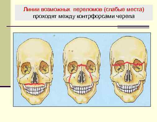 Линии возможных переломов (слабые места) проходят между контрфорсами черепа 