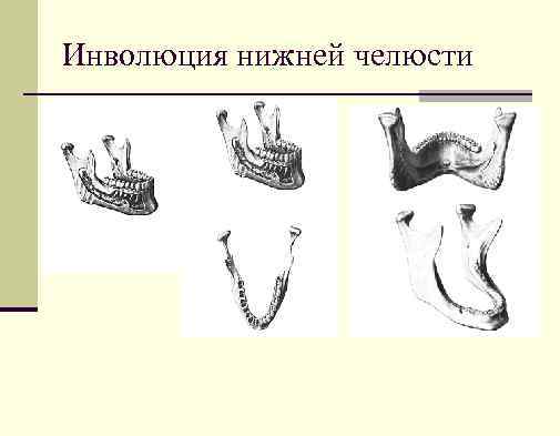 Инволюция нижней челюсти 