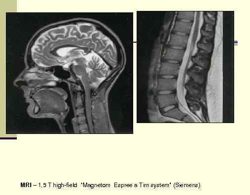 MRI – 1, 5 T high-field “Magnetom Espree a Tim system” (Siemens). 