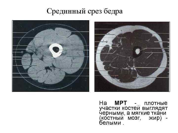 Срединный срез бедра На МРТ - плотные участки костей выглядят черными, а мягкие ткани