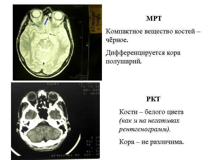 МРТ Компактное вещество костей – чёрное. Дифференцируется кора полушарий. РКТ Кости – белого цвета