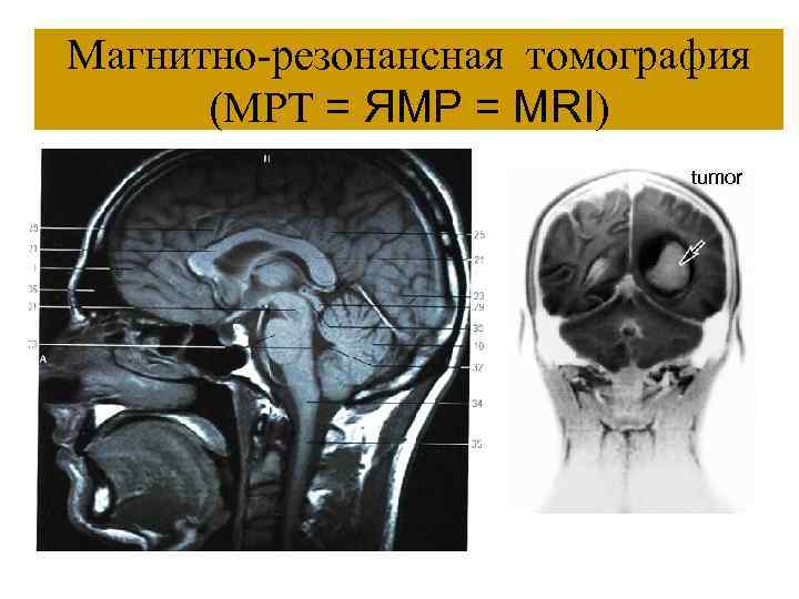 Магнитно-резонансная томография (МРТ = ЯМР = MRI) tumor 