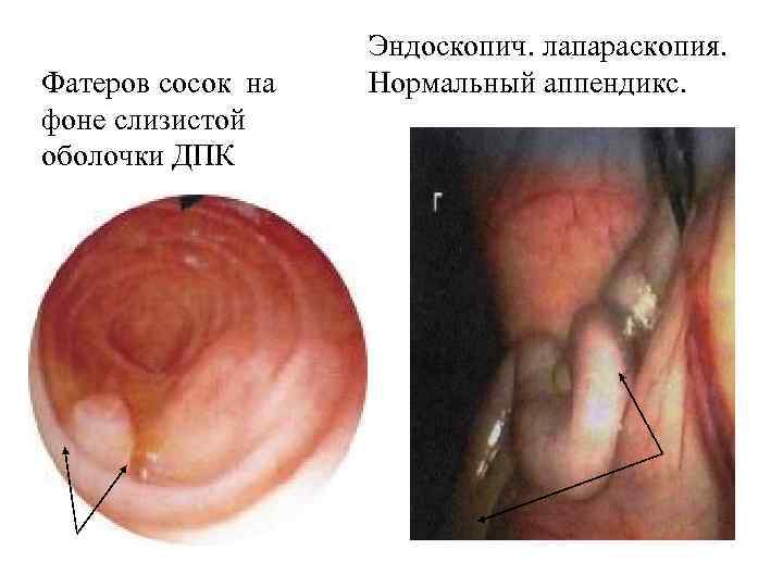 Фатеров сосок на фоне слизистой оболочки ДПК Эндоскопич. лапараскопия. Нормальный аппендикс. 