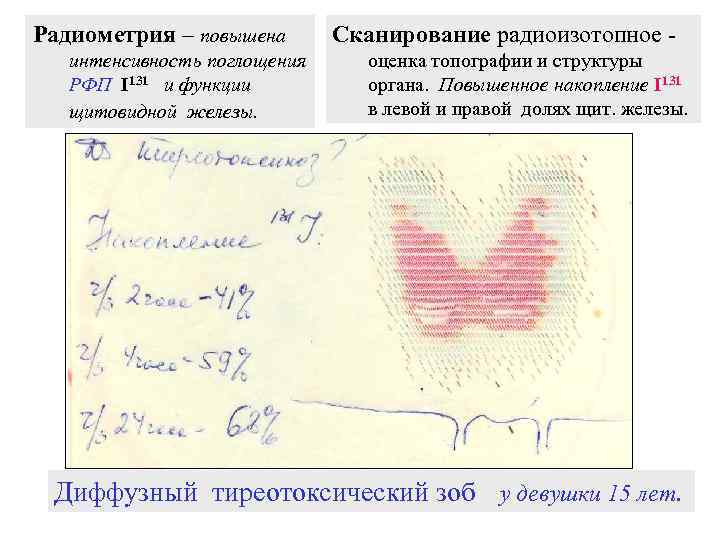 Радиометрия – повышена интенсивность поглощения РФП I 131 и функции щитовидной железы. Сканирование радиоизотопное