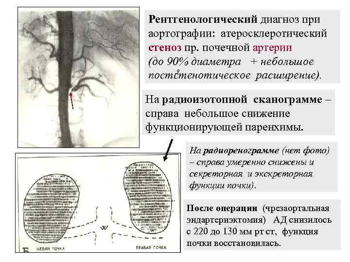Рентгенологический диагноз при аортографии: атеросклеротический стеноз пр. почечной артерии (до 90% диаметра + небольшое