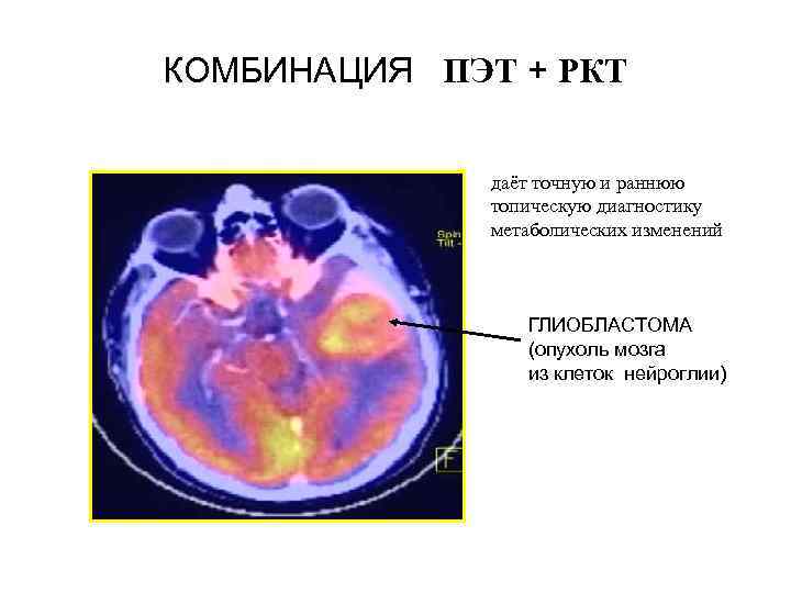КОМБИНАЦИЯ ПЭТ + РКТ даёт точную и раннюю топическую диагностику метаболических изменений ГЛИОБЛАСТОМА (опухоль