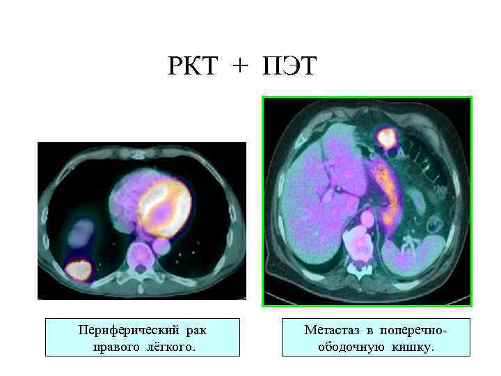 РКТ + ПЭТ Периферический рак правого лёгкого. Метастаз в поперечноободочную кишку. 