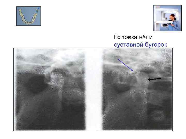 Головка н/ч и суставной бугорок 