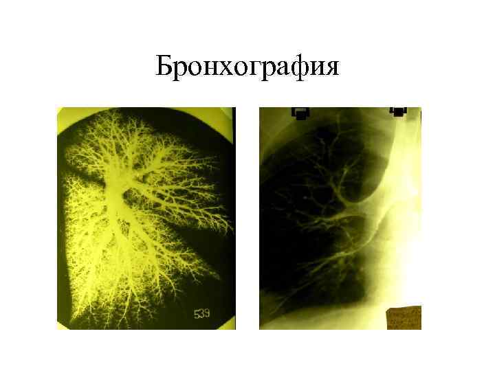 Бронхография 