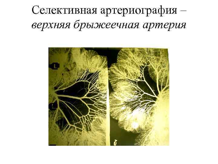 Селективная артериография – верхняя брыжеечная артерия 